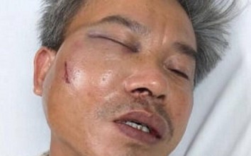 Chụp ảnh quán cafe Bố Già, nhân viên cây xanh ở Huế bị đánh gãy xương hàm