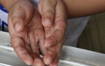 TP.HCM: 21/24 quận huyện báo động gia tăng bệnh tay chân miệng