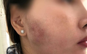 Người phụ nữ 33 tuổi đau nhức, biến dạng mặt sau 1 năm “tiêm má baby”