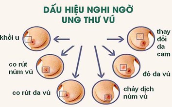 Cần làm gì để phòng ngừa ung thư vú?