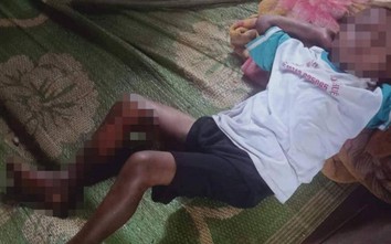Khởi tố nam thanh niên làm bé trai 8 tuổi ở Đắk Lắk bị bỏng