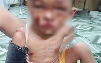 Thông tin mới nhất tình hình sức khoẻ bé trai bị bạo hành ở TP.HCM